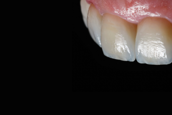 Veneers Banners